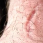 Bite Marks Bite Marks Simplyforensic