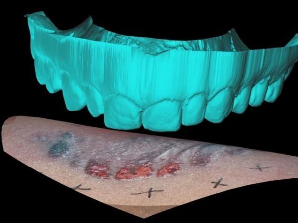 bites Simplyforensic