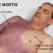 Livor Mortis Postmortem Lividity and Blanching A medical diagram showing a deceased person with areas of postmortem lividity discoloration and a distinct area of blanching or contact pallor used to explain livor mortis Simplyforensic