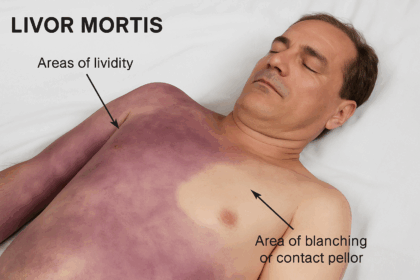 A medical diagram showing a deceased person with areas of postmortem lividity (discoloration) and a distinct area of blanching or contact pallor, used to explain livor mortis.