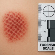 abrasion A clinical non graphic image showing a patterned abrasion on skin with a forensic scale for measurement Simplyforensic